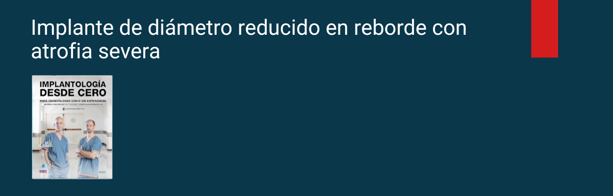 Implante de diámetro reducido en reborde con atrofia severa