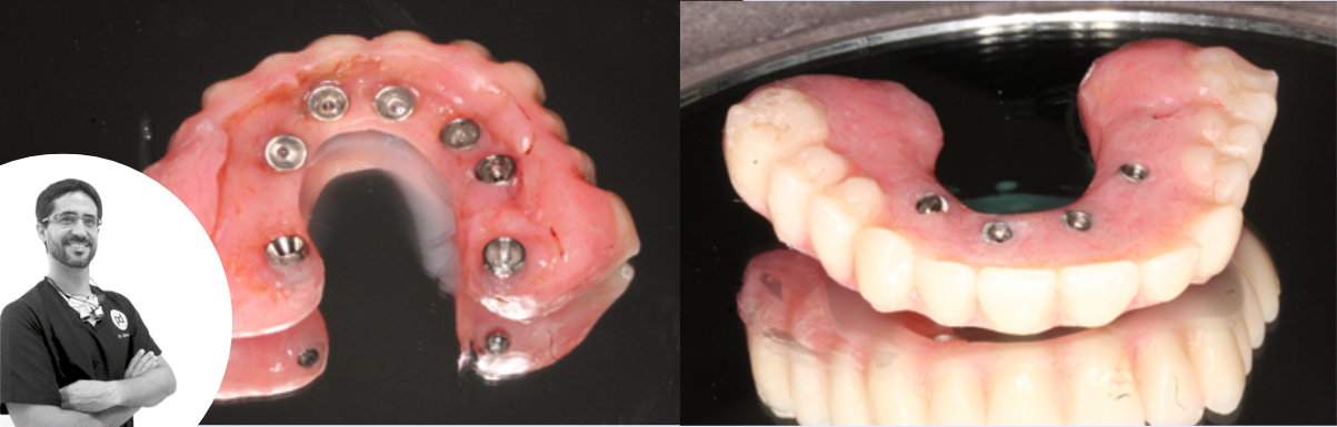 Colocación de 2 implantes cigomáticos y 2 implantes pterigoideos en maxilar superior mediante sedación intravenosa