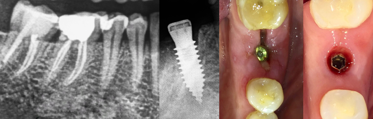 Control a 10 años de implante Odontit Heximplant